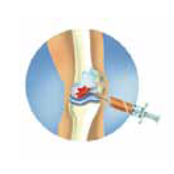 Etapy przygotowania - leczenie metodą Orthokine - Terapia Orthokine
